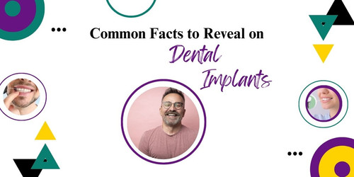 Common Facts to Reveal on Dental Implants.jpg