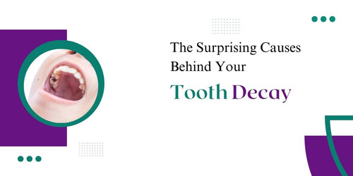 The Surprising Causes Behind Your Tooth Decay.jpg
