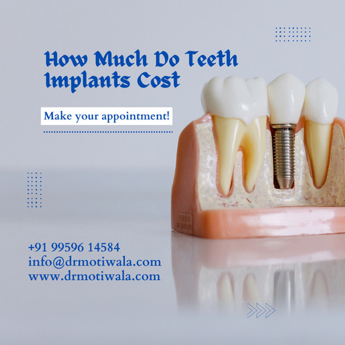 How Much Do Teeth Implants Cost.jpg