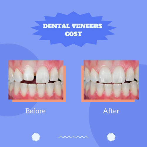 Dental Veneers Cost.jpg