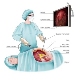 Laparoscopy surgery.jpg