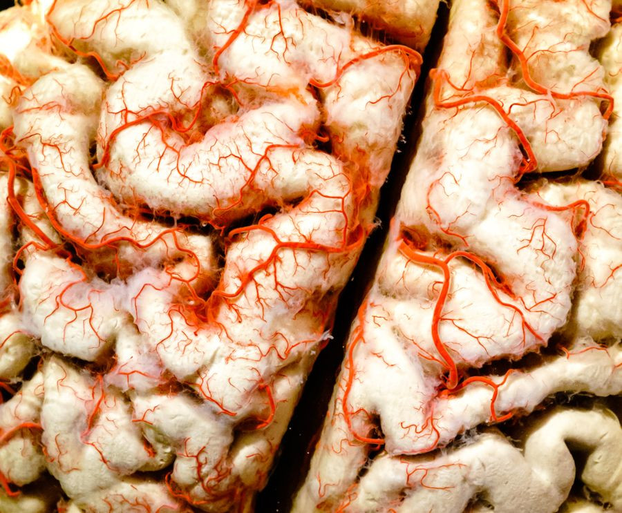 Nuovo studio rileva microplastiche nel tessuto cerebrale umano