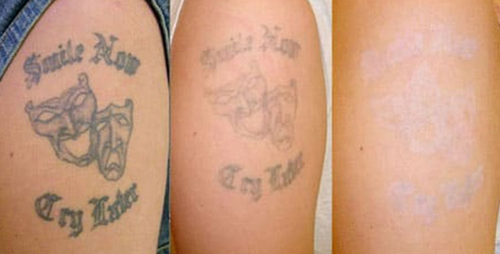 Best Laser tattoo removal From blastherbv.png