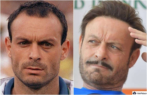 toto schillaci trapianto capelli prima e dopo.jpg