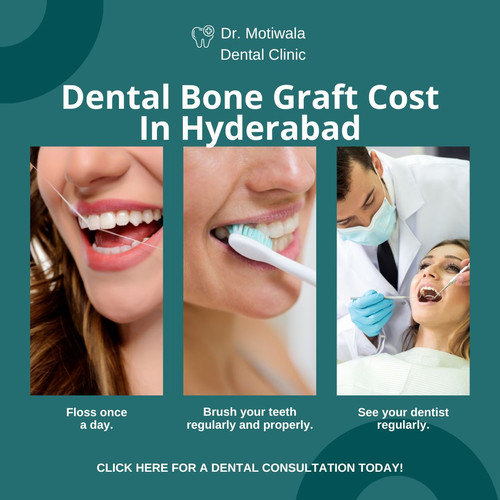 Dental Bone Graft Cost In Hyderabad.jpg