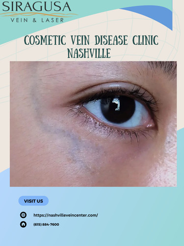 Cosmetic vein disease clinic nashville.jpg