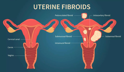 Fibroid Pictures | Visual Guide to Understanding Fibroids.jpg
