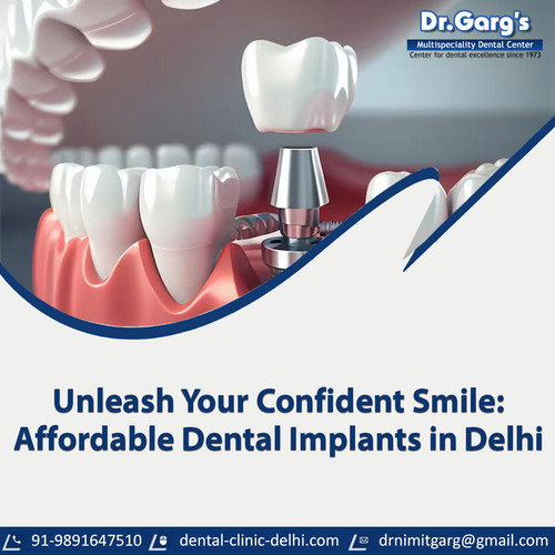 Unleash Your Confident Smile: Affordable Dental Implants in Delhi.jpg