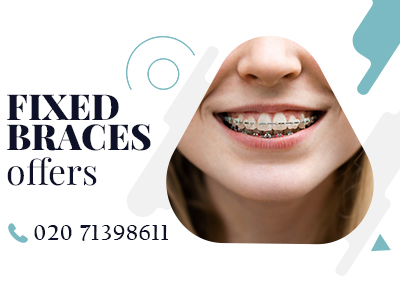 Fixed braces offers.jpg