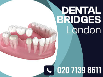 Dental Bridges London.jpg