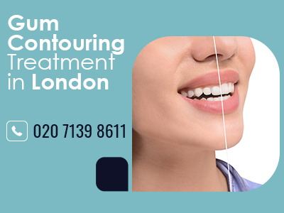 Gum Contouring Treatment in London.jpg