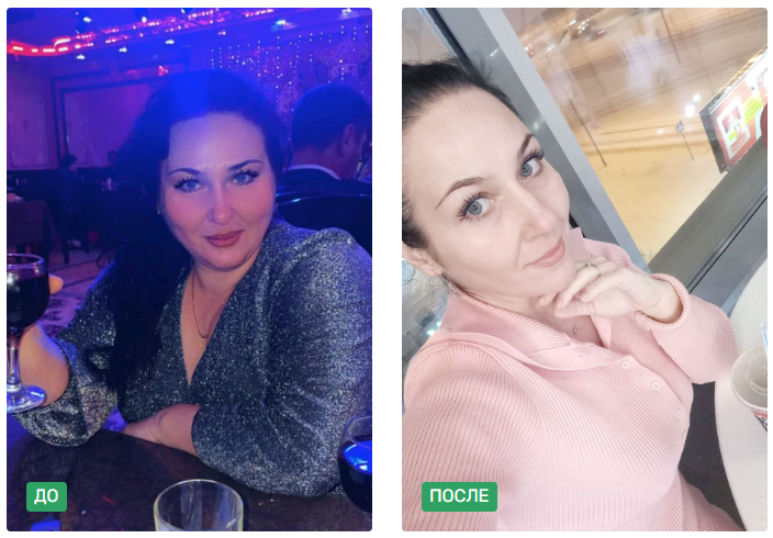 Как худеют при помощи бариатрических операций: отзыв пациентки