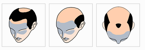How can I know the toupee size I need3.png