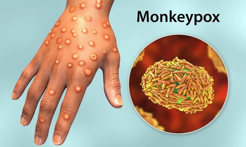 mpox2401.jpg