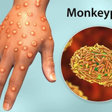 mpox2401