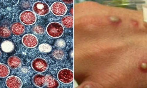 mpox2406.jpg