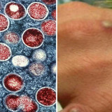 mpox2406