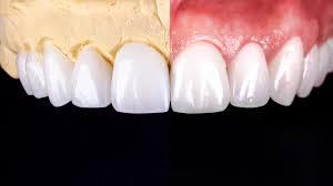 All on 4 dental implants tijuana Mexico.jpg