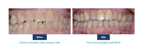 Cavity Free.png