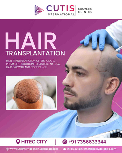 What are the Benefits of Hair Transplantation for Hair Regrowth?.jpg