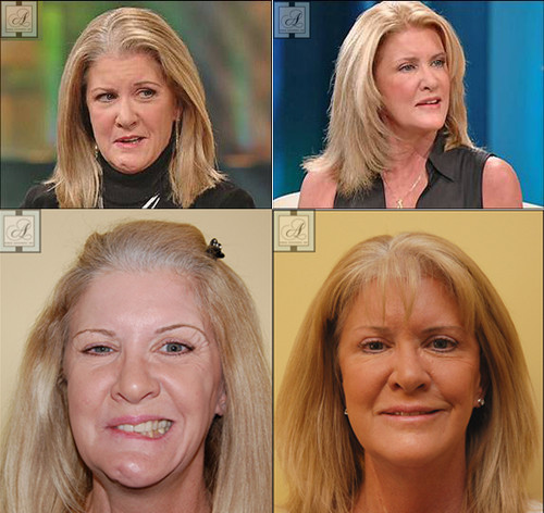 Facial Paralysis Plastic Surgery.jpg