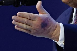 تداول ناشطون صورة حديثة للرئيس الأميركي دونالد ترمب تظهر وجود كدمة واضحة على يده، ما أثار موجة من التساؤلات والجدل حول حالته الصحية، وسط مخاوف من أن ت...