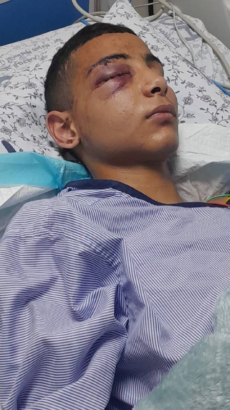 صورة | الطفل نبيل لؤي أصلان يُجري عملية لإزالة العين في مستشفى نابلس (النجاح)، يذكر أنه أصيب خلال اقتحام قوات الاحتلال لمخيم قلنديا وبلدة كفر عقب شمال...