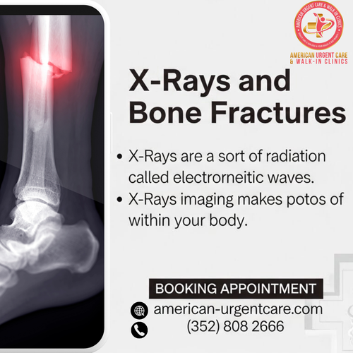 X Rays and Bone Fractures.png
