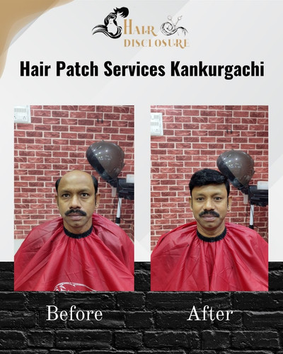 Best hair patch services Kankurgachi -Hair Disclosure.jpg
