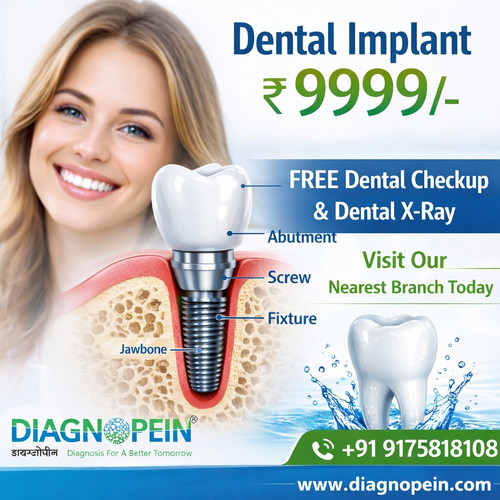 Dental Implant (2).jpg