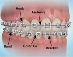Grand Rapids Clear Braces.jpg