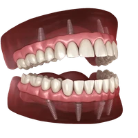 dental implants.png