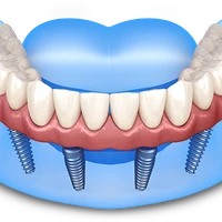 denture repair.png