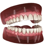 dental implants