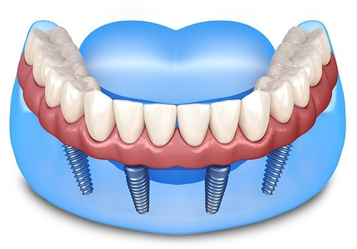 All On 4 Implants Albany.jpg