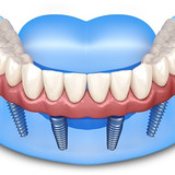 All On 4 Implants Albany