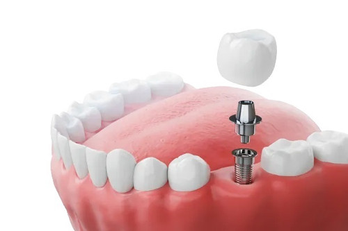 All On 4 Implants Albany.jpg