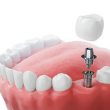 All On 4 Implants Albany