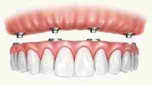 All On 4 Implants Albany.jpg