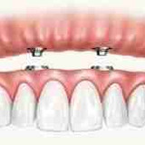 All On 4 Implants Albany