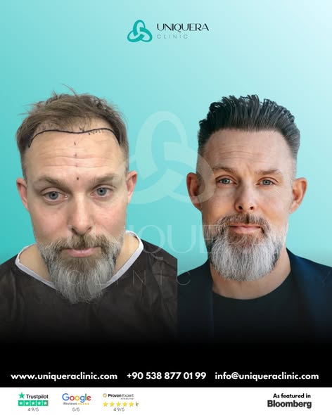 Direct Hair Implantation.jpg