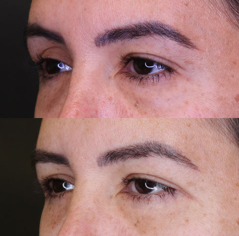 Blepharoplasty.jpg