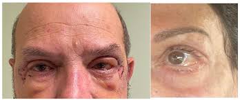 Blepharoplasty Salt Lake City | Expert Eyelid Lift for Natural Results.jpg
