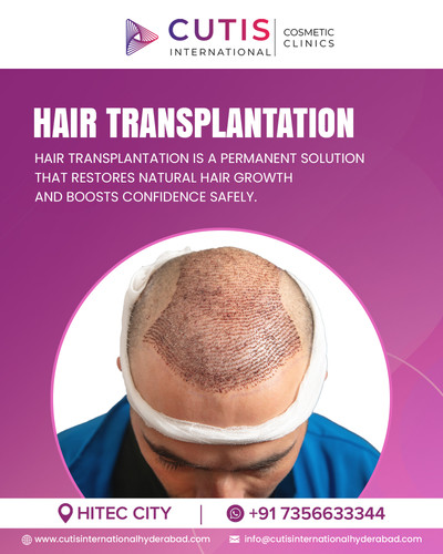 What are the Benefits of Hair Transplantation?.jpg