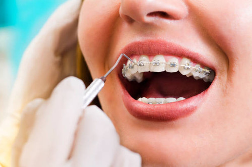 Orthodontic care is not just for teenagers adults can benefit from braces at any stage of life. Our practice offers a range of adult braces options designed to straighten teeth effectively while maintaining comfort and convenience.

Learn More- https://www.ocortho.net/treatments