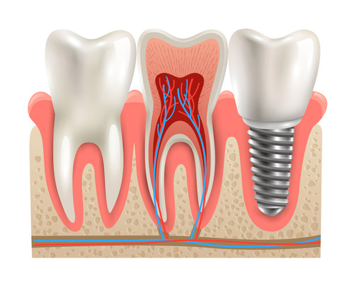 Dental implant and real tooth anatomy closeup cut away section model side view realistic vector illu.jpg