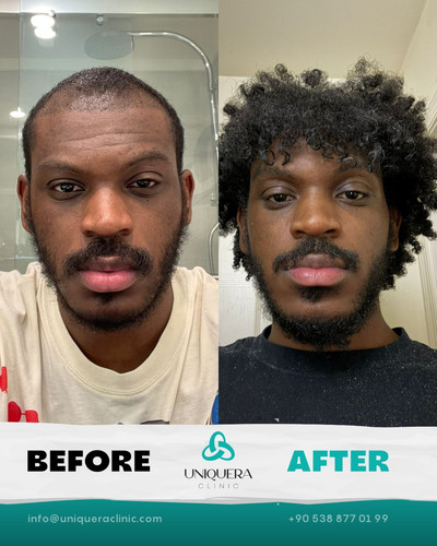 Manual Hair Transplant in Turkey.jpg