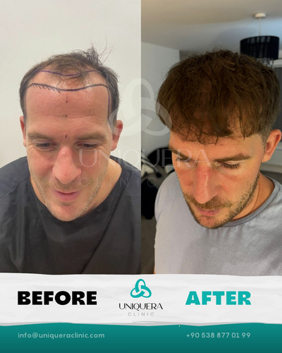 Dhi Hair Transplant Istanbul.jpg