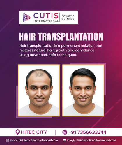 What Makes a Good Hair Transplant Clinic Key Factors?.jpg
