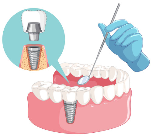 Dental implants south london (1).jpg